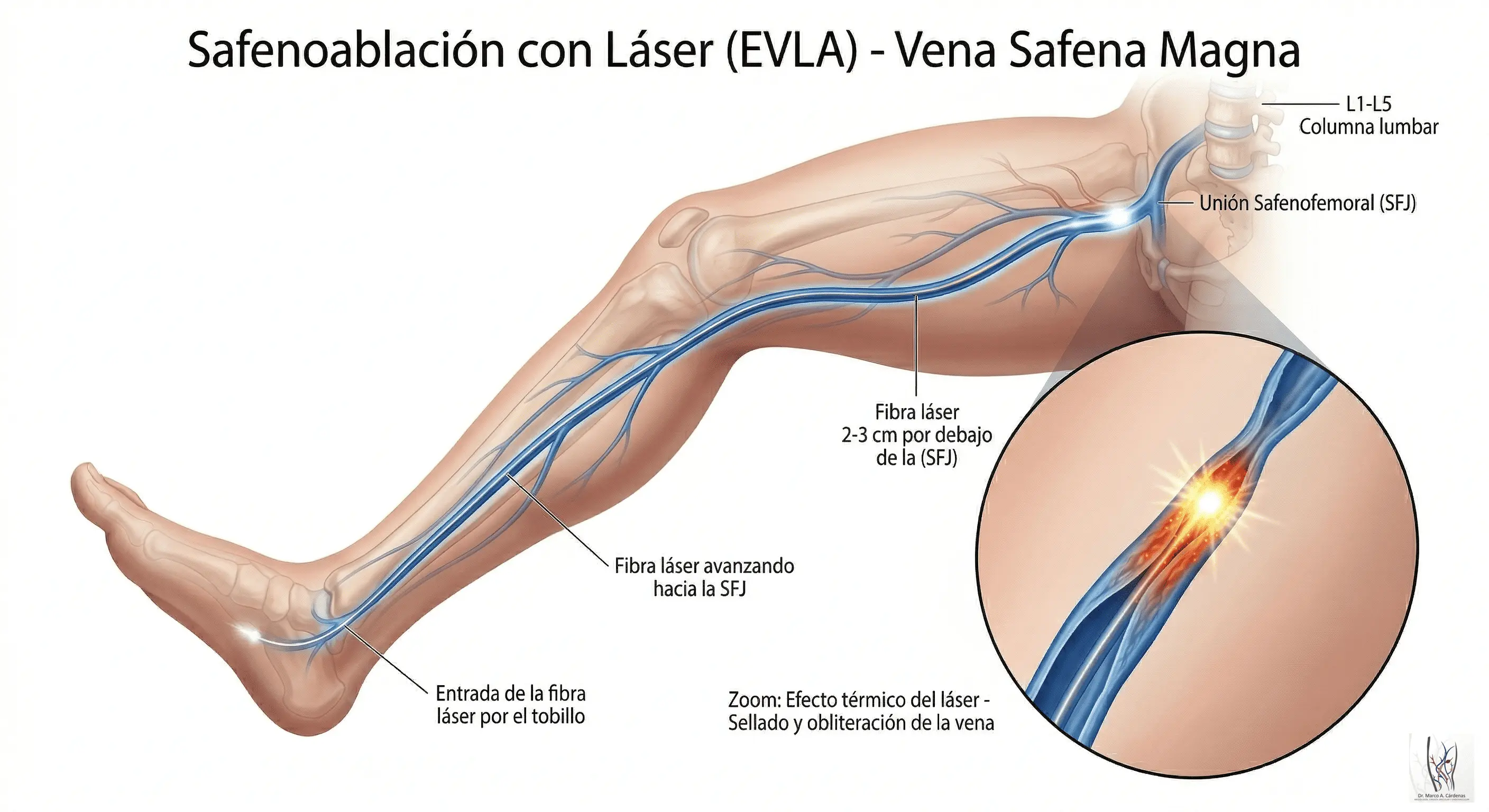 Ablación Láser Endovenosa